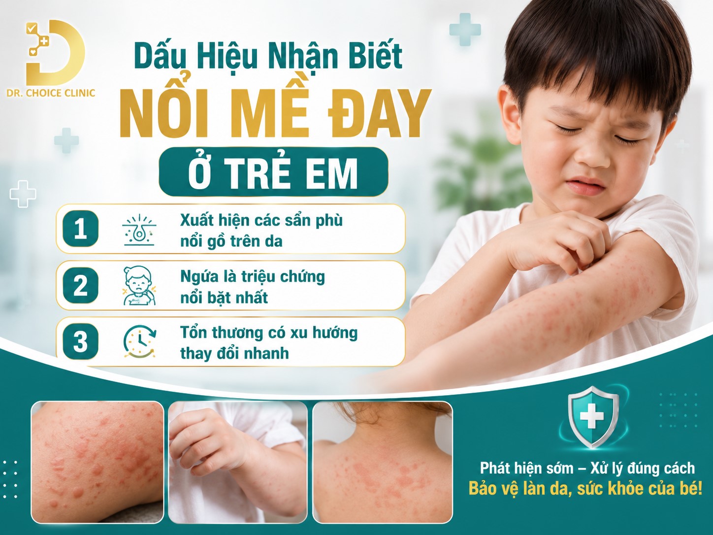 Dấu hiệu nhận biết nổi mề đay ở trẻ em