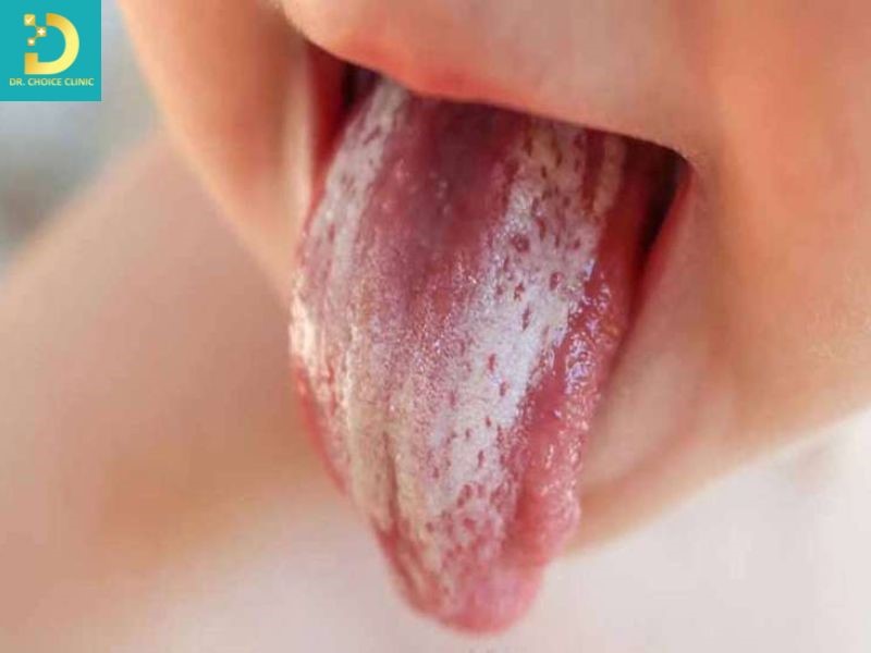 Dấu hiệu gợi ý bội nhiễm nấm Candida