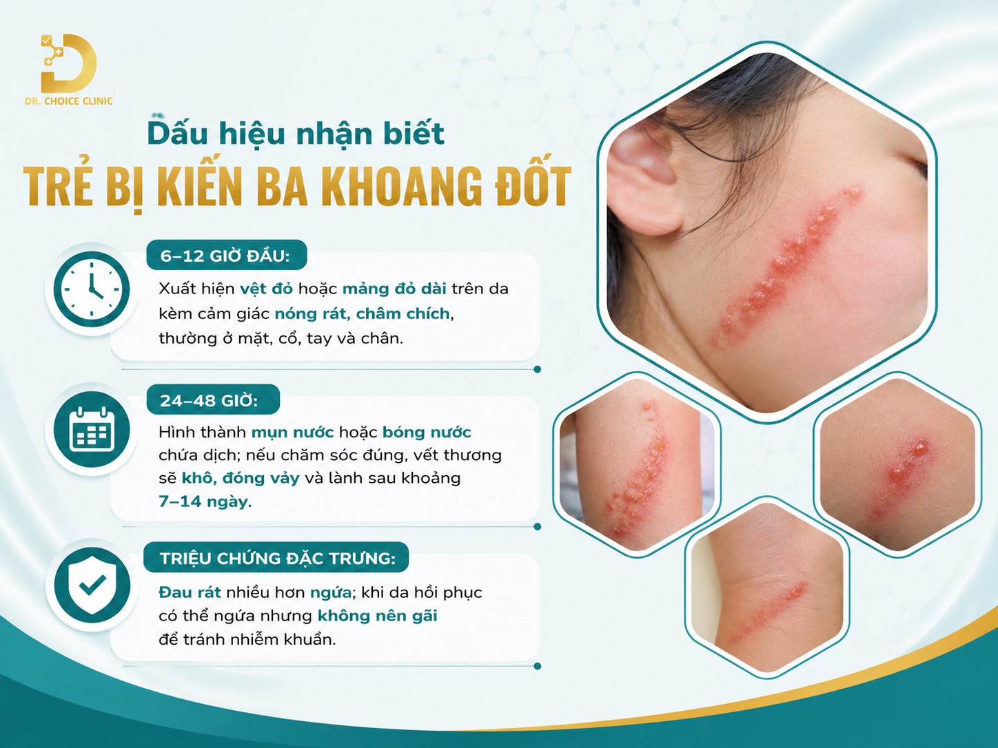 Xử Lý Khi Trẻ Bị Kiến Ba Khoang Đốt Tránh Bị Loét Da 11 Dấu hiệu nhận biết trẻ bị kiến ba khoang đốt