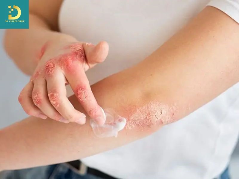 Các Bệnh Da Do Vi Nấm Thường Gặp Và Cách Điều Trị 18 Cần lưu ý khi dùng thuốc bôi phối hợp có chứa corticoid mạnh