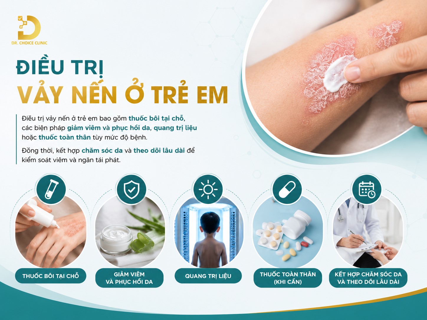 Bệnh Vảy Nến Ở Trẻ Em: Nguyên Nhân, Triệu Chứng, Chẩn Đoán & Điều Trị 13 Điều trị vảy nến ở trẻ em