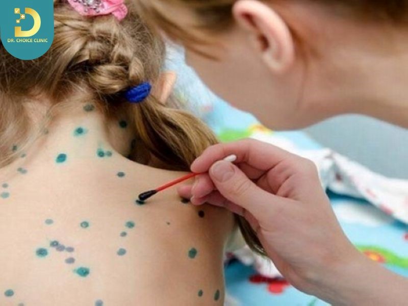 Trẻ Bị Thủy Đậu Phải Làm Sao? Cách Chăm Sóc An Toàn Không Để Lại Sẹo 11 Điều trị trẻ bị thủy đậu