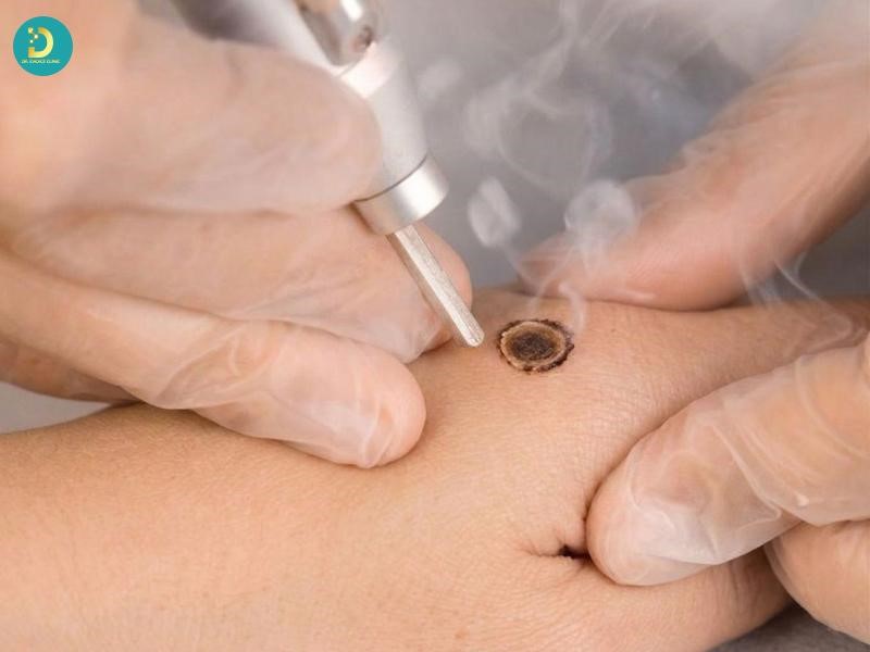 Điều trị mụn cóc bằng các phương pháp y khoa