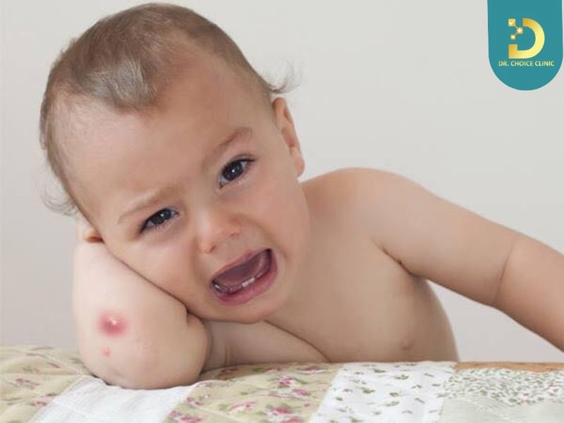 Mụn Nhọt Ở Trẻ Em: Nguyên Nhân, Triệu Chứng Và Cách Xử Lý An Toàn 8 Trẻ em bị mụn nhọt (ảnh minh họa)