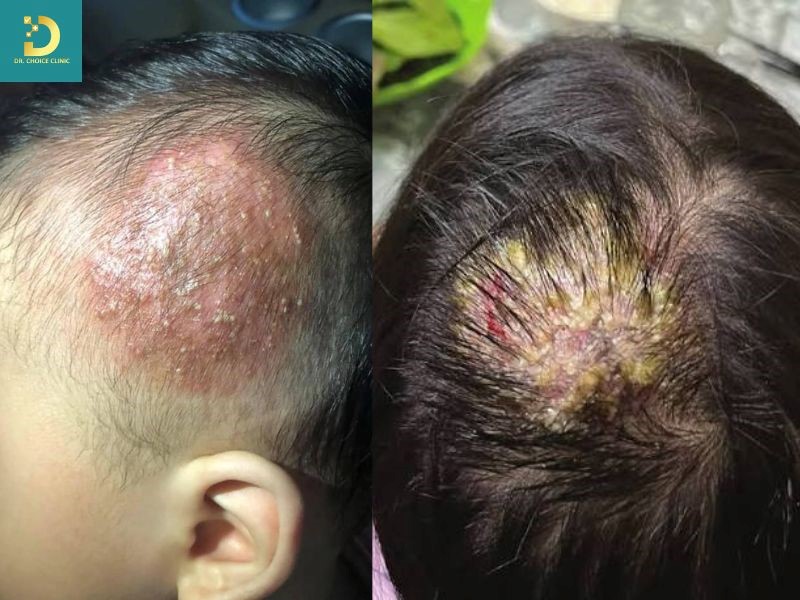 Nấm Da Đầu Ở Trẻ Em Có Nguy Hiểm Không? Cách Chữa Hiệu Quả 8 Nấm da đầu ở trẻ em thường biểu hiện bằng ngứa, bong vảy và rụng tóc thành từng mảng