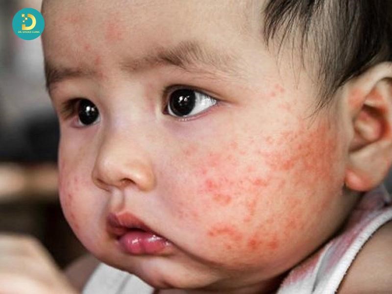 Phân Biệt Chàm Sữa Và Rôm Sảy: Khác Nhau Như Thế Nào? 8 Trẻ bị chàm sữa (ảnh minh họa)