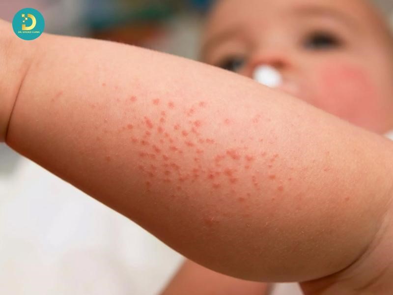 Phân Biệt Chàm Sữa Và Rôm Sảy: Khác Nhau Như Thế Nào? 9 Trẻ bị rôm sảy (ảnh minh họa)