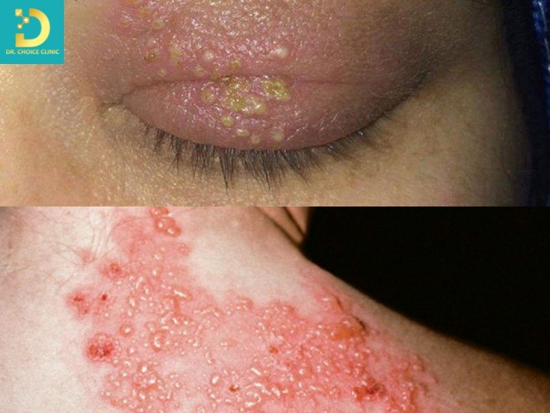 Zona Thần Kinh: Nguyên Nhân, Triệu Chứng, Cách Điều Trị Và Phòng Ngừa 9 Bệnh zona thần kinh (ảnh minh họa)