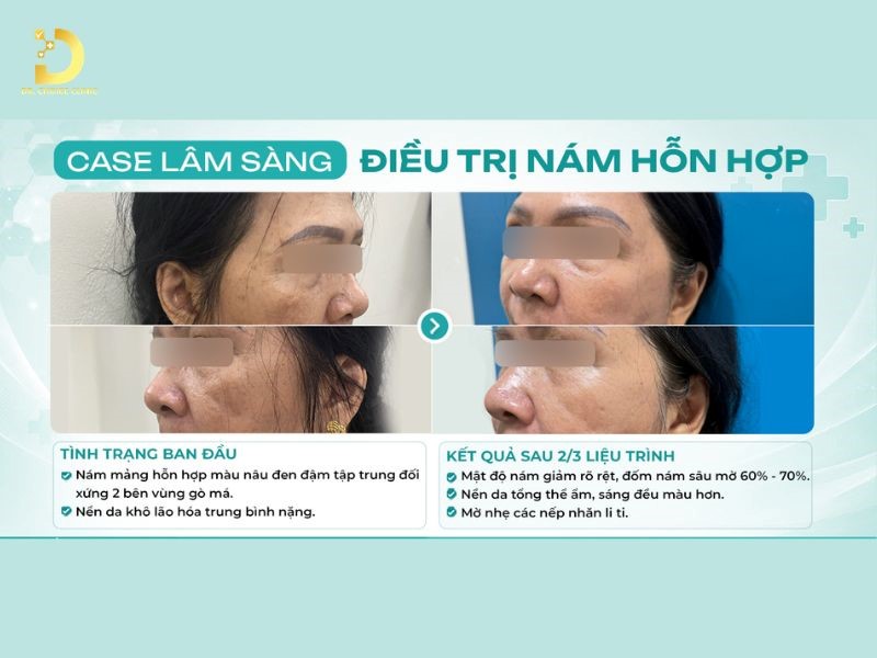 Các Bệnh Về Da Do Ánh Nắng Mặt Trời: Cách Ngăn Ngừa & Điều Trị Hiệu Quả 24 Kết quả điều trị nám hỗn hợp.