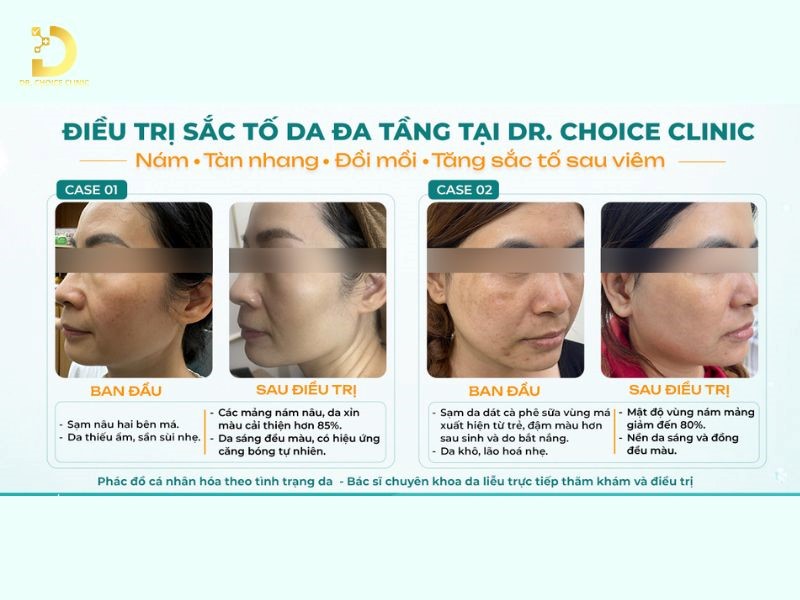 Các Bệnh Về Da Do Ánh Nắng Mặt Trời: Cách Ngăn Ngừa & Điều Trị Hiệu Quả 25 Kết quả điều trị sắc tố đa tầng.
