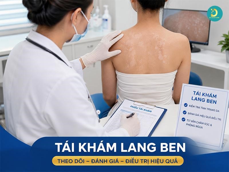 Lang Ben: Nguyên Nhân, Dấu Hiệu & Cách Điều Trị, Phòng Ngừa 17 Những trường hợp cần tái khám khi bị lang ben