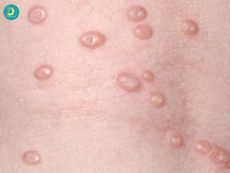 Mụn cóc là bệnh có khả năng lây truyền