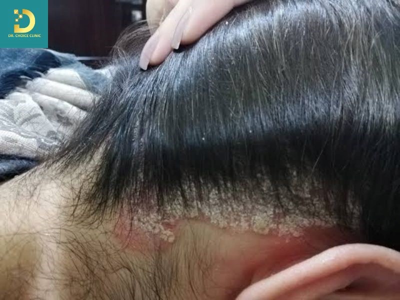 Các Bệnh Da Do Vi Nấm Thường Gặp Và Cách Điều Trị 16 Nấm da đầu (ảnh minh họa)