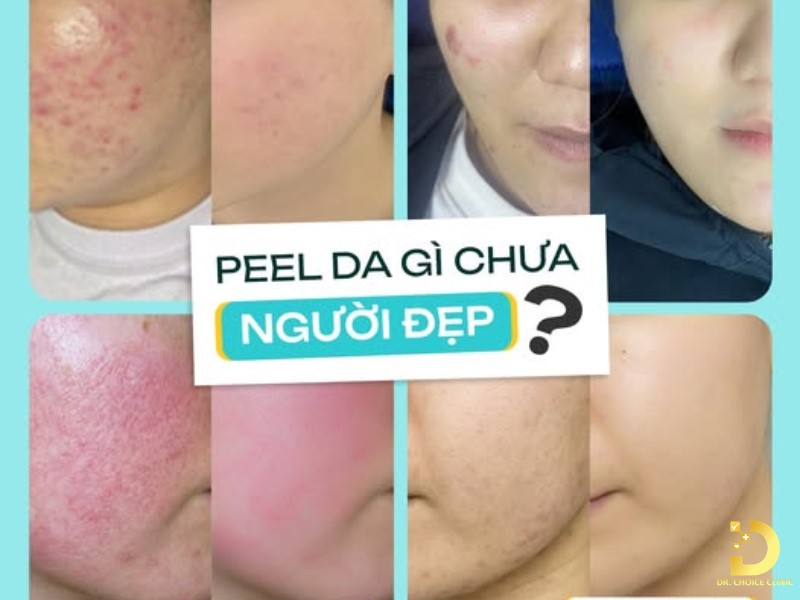 Da Lão Hóa Nhanh Vào Mùa Hè: Nguyên Nhân & Cách Chăm Da Hiệu Quả 14 Hình ảnh trước và sau khi peel da trẻ hóa tại Dr. Choice Clinic.