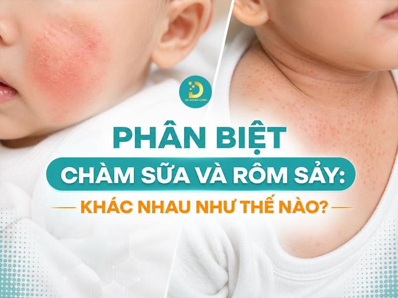 Phân Biệt Chàm Sữa Và Rôm Sảy: Khác Nhau Như Thế Nào? 7 Phân biệt chàm sữa và rôm sảy ở trẻ em