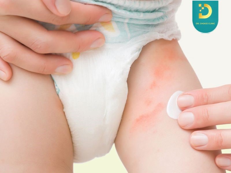 Bệnh ghẻ và chốc lở ở trẻ (ảnh minh họa)