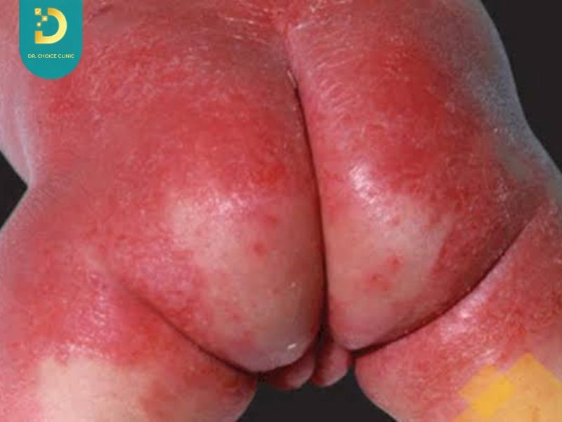 Viêm da tiết bã ở trẻ nhũ nhi (ảnh minh họa)