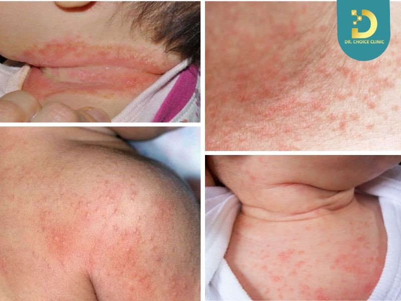 Trẻ Bị Rôm Sảy Tắm Lá Gì? Lưu Ý Điều Trị An Toàn 10 Rôm sảy hay còn gọi là phát ban nhiệt, là hiện tượng da nổi các nốt mẩn đỏ nhỏ li ti