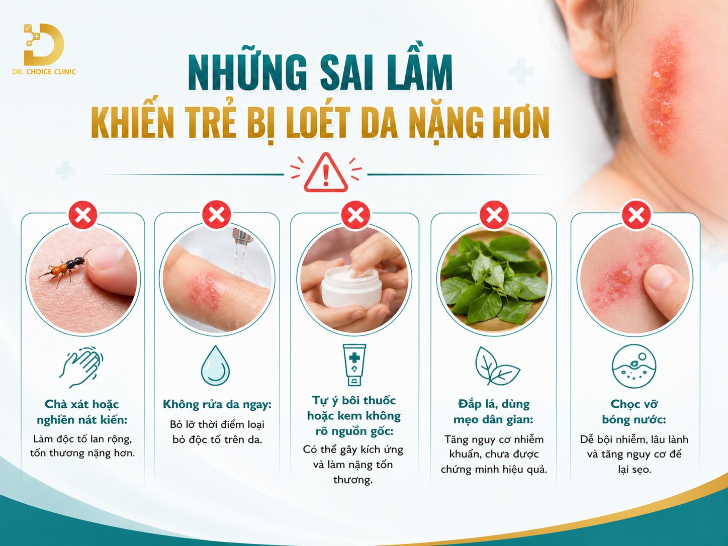 Xử Lý Khi Trẻ Bị Kiến Ba Khoang Đốt Tránh Bị Loét Da 14 Sai lầm khiến trẻ bị loét da nặng hơn khi điều trị kiến ba khoang đốt