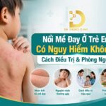 Tìm hiểu về mề đay ở trẻ em