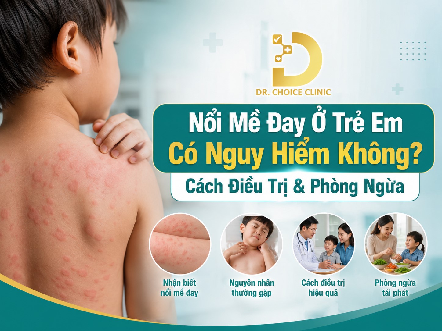 Tìm hiểu về mề đay ở trẻ em