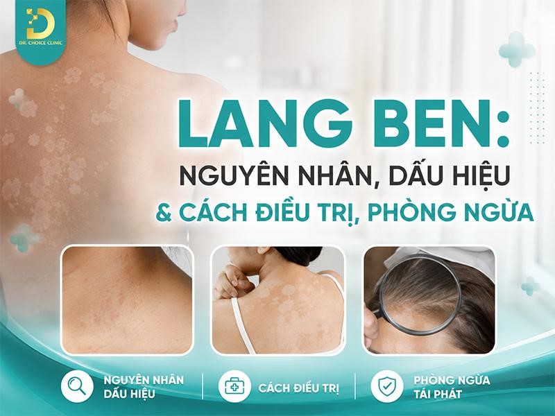 Lang Ben: Nguyên Nhân, Dấu Hiệu & Cách Điều Trị, Phòng Ngừa 10 Tìm hiểu về bệnh lang ben