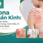 Tìm hiểu về Zona thần kinh