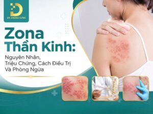 Tìm hiểu về Zona thần kinh