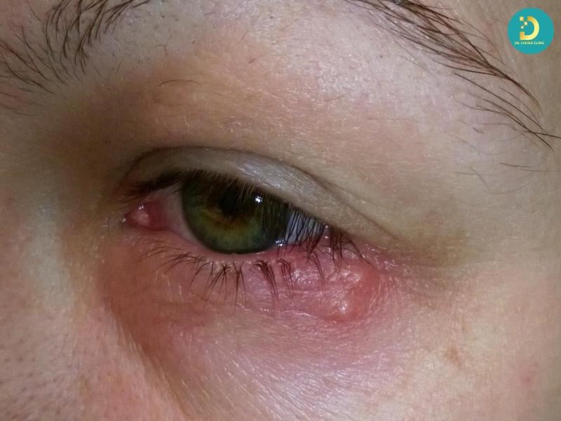Herpes Là Gì? Nguyên Nhân, Dấu Hiệu & Cách Điều Trị, Phòng Ngừa 15 Triệu chứng bệnh Herpes (ảnh minh họa)