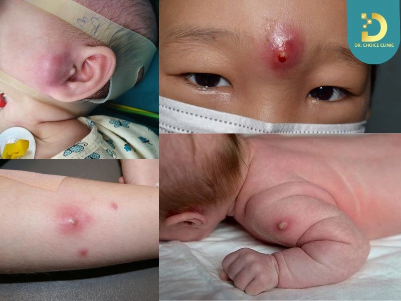Mụn Nhọt Ở Trẻ Em: Nguyên Nhân, Triệu Chứng Và Cách Xử Lý An Toàn 9 Triệu chứng mụn nhọt ở trẻ em
