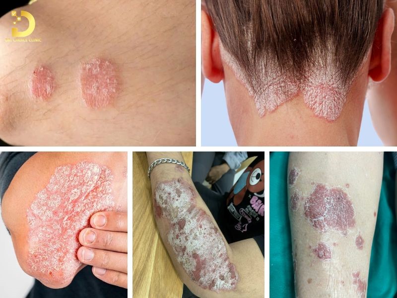 Bệnh Vảy Nến Ở Trẻ Em: Nguyên Nhân, Triệu Chứng, Chẩn Đoán & Điều Trị 9 Bệnh vảy nến ở trẻ em (ảnh minh họa)