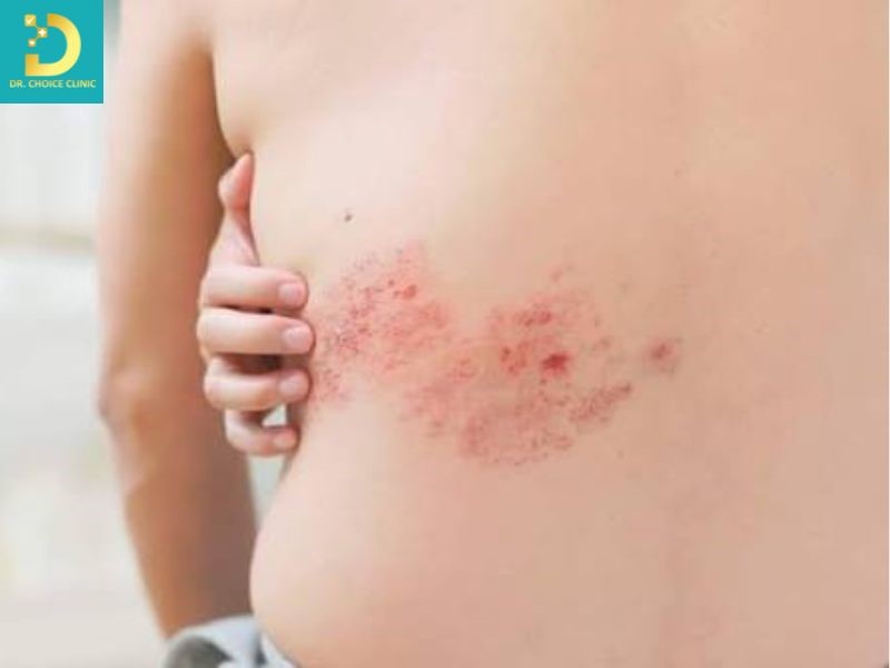 Zona Thần Kinh: Nguyên Nhân, Triệu Chứng, Cách Điều Trị Và Phòng Ngừa 10 Triệu chứng zona thần kinh