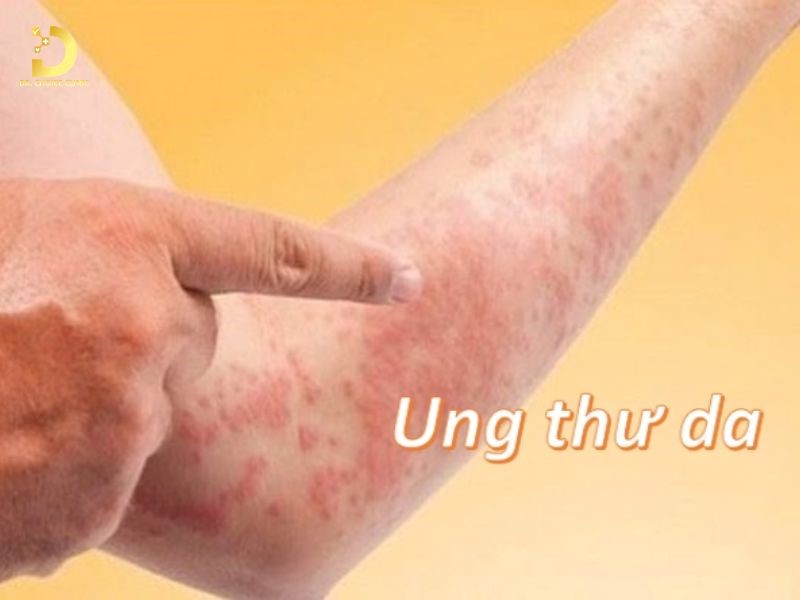 Các Bệnh Về Da Do Ánh Nắng Mặt Trời: Cách Ngăn Ngừa & Điều Trị Hiệu Quả 19 Ung thư da do nắng