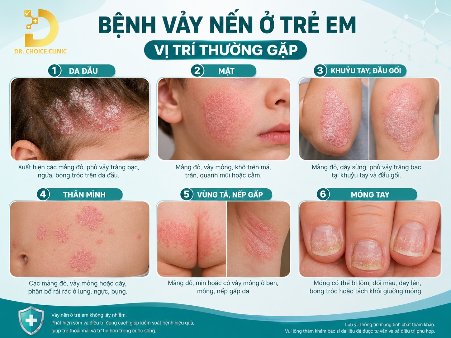 Bệnh Vảy Nến Ở Trẻ Em: Nguyên Nhân, Triệu Chứng, Chẩn Đoán & Điều Trị 11 Các vị trí trẻ em dễ gặp bệnh vảy nến