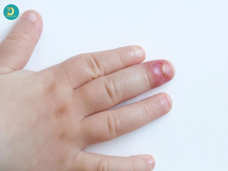 Trẻ em đối tượng dễ bị mụn cóc