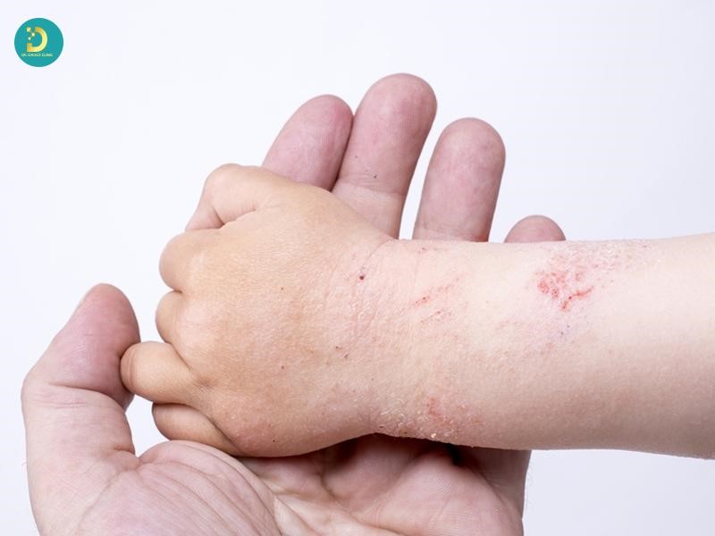 Da bị trầy xước làm tăng nguy cơ lây bệnh