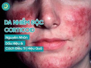 Da nhiễm độc corticoid: nguyên nhân, triệu chứng, điều trị