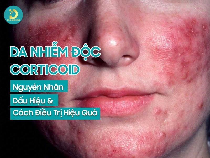 Da Nhiễm Độc Corticoid: Nguyên Nhân, Dấu Hiệu & Cách Điều Trị 10 Da nhiễm độc corticoid: nguyên nhân, triệu chứng, điều trị