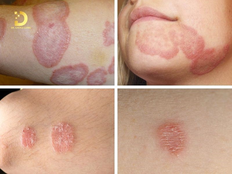 Hắc Lào: Nguyên Nhân, Dấu Hiệu & Cách Điều Trị, Phòng Ngừa 11 Dấu hiệu nhận biết bệnh hắc lào