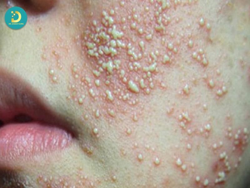 Da Nhiễm Độc Corticoid: Nguyên Nhân, Dấu Hiệu & Cách Điều Trị 14 Dấu hiệu giai đoạn nhiễm độc corticoid tiến triển nặng