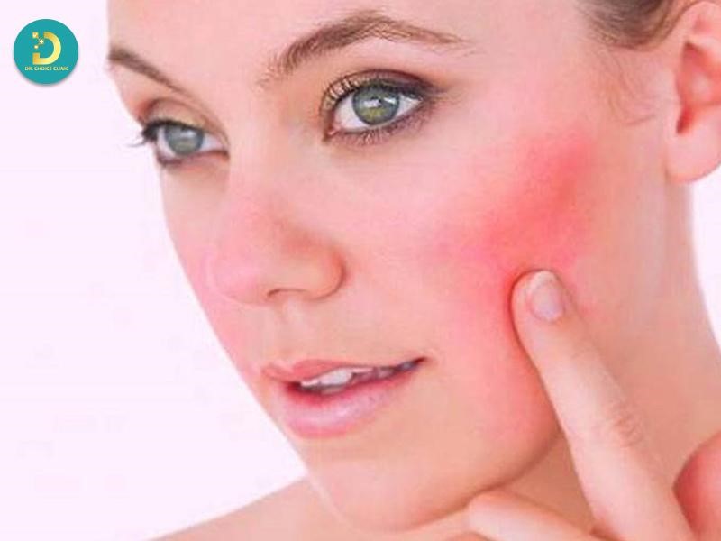 Da Nhiễm Độc Corticoid: Nguyên Nhân, Dấu Hiệu & Cách Điều Trị 13 Dấu hiệu nhận biết da nhiễm corticoid