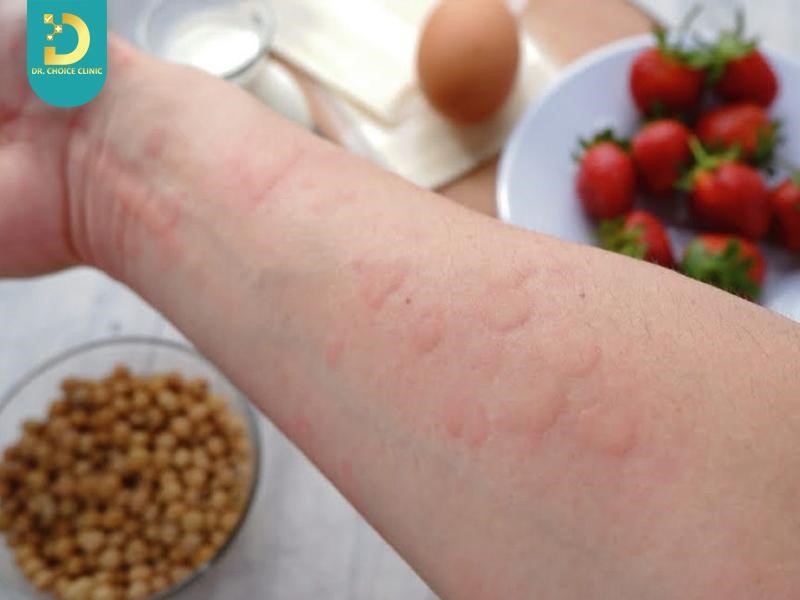 Kích Ứng Và Dị Ứng Da Khác Nhau Thế Nào? Cách Khắc Phục 10 Dấu hiệu dị ứng da