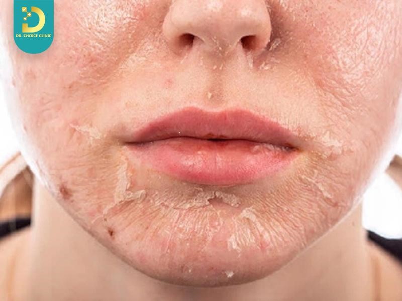 Kích Ứng Và Dị Ứng Da Khác Nhau Thế Nào? Cách Khắc Phục 9 Dấu hiệu kích ứng da