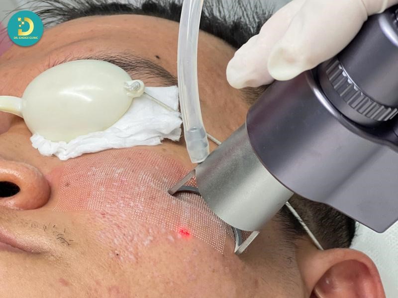 Da Nhiễm Độc Corticoid: Nguyên Nhân, Dấu Hiệu & Cách Điều Trị 17 Điều trị da nhiễm corticoid hỗ trợ bằng công nghệ laser và ánh sáng sinh học.