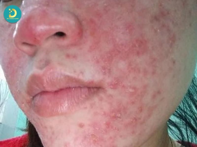 Da Nhiễm Độc Corticoid: Nguyên Nhân, Dấu Hiệu & Cách Điều Trị 11 Da nhiễm độc corticoid (ảnh minh họa)