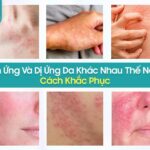 Tìm hiểu kích ứng da và dị ứng da