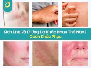 Tìm hiểu kích ứng da và dị ứng da